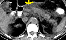 PANCREATIC TRAUMA