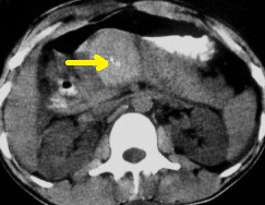 PANCREATIC TRAUMA