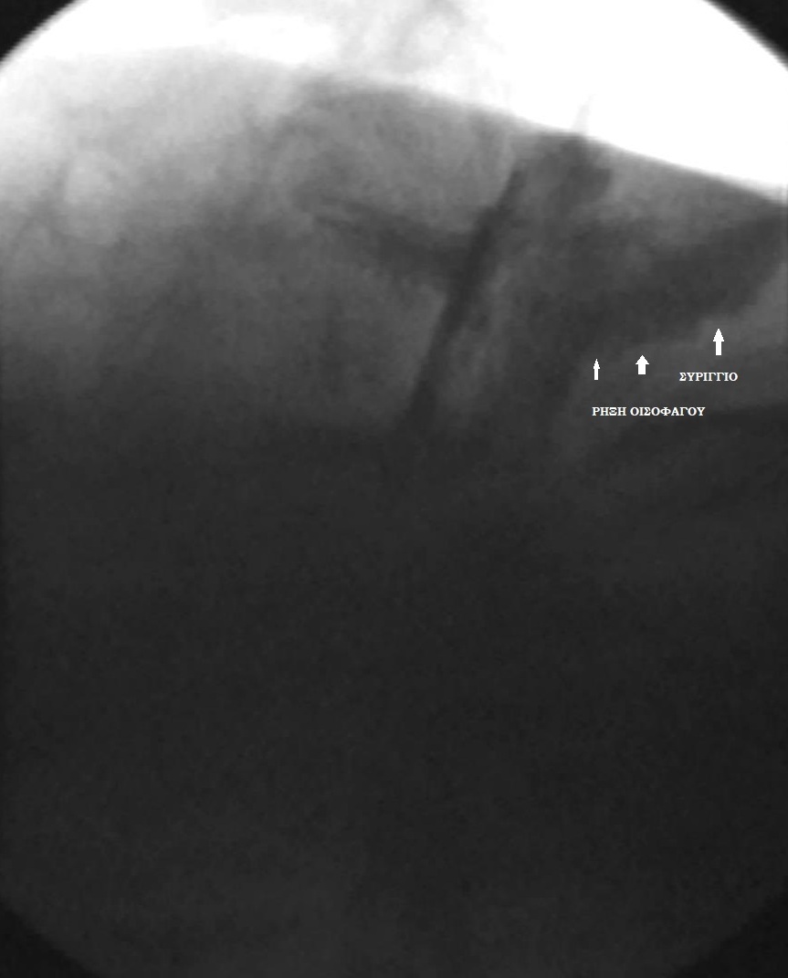 ESOPHAGEAL LACERATION