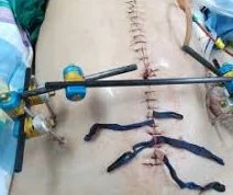 EXTERNAL PELVIC FIXATION