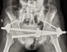 OPEN BOOK PELVIC FRACTURE