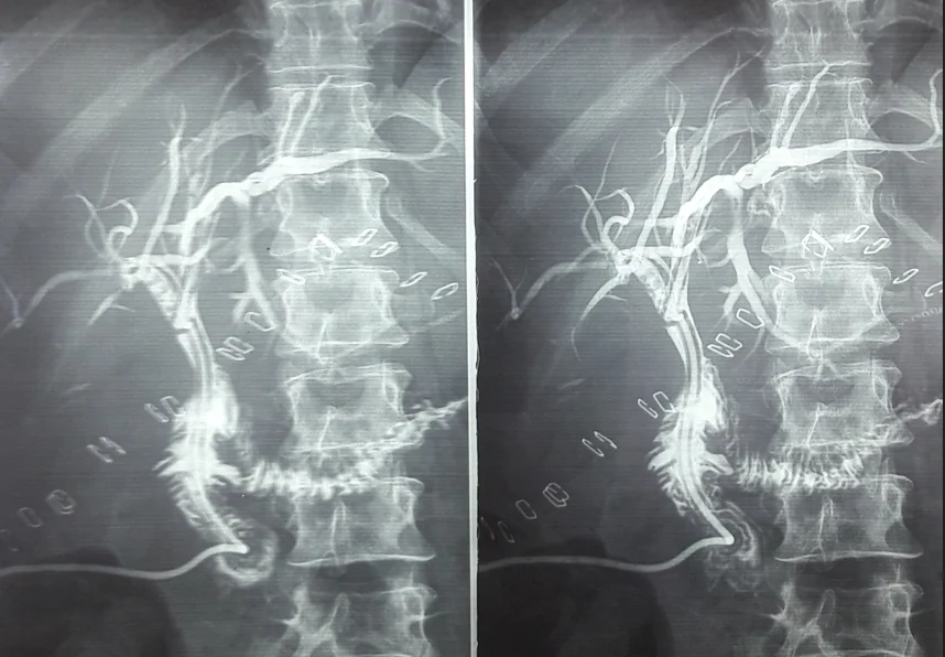 COMMON BILE DUCT TRANSECTION REPAIR
