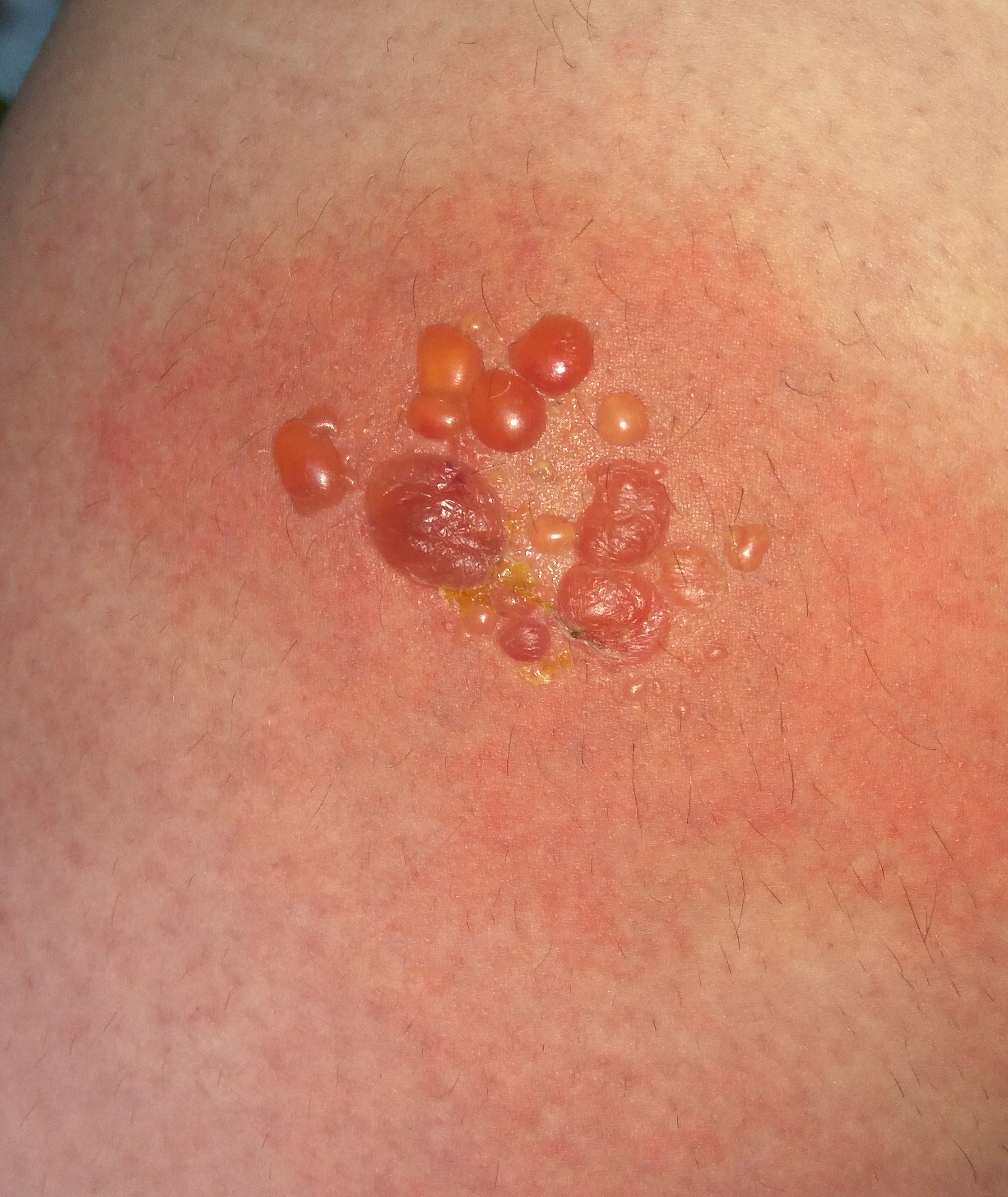 INSECT BITE