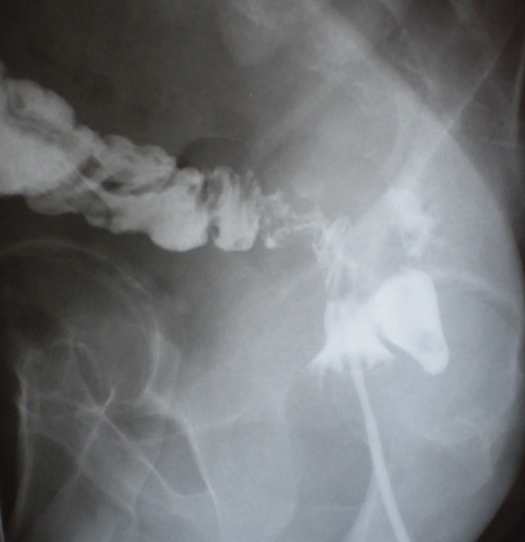 IATROGENIC RECTAL LACERATION