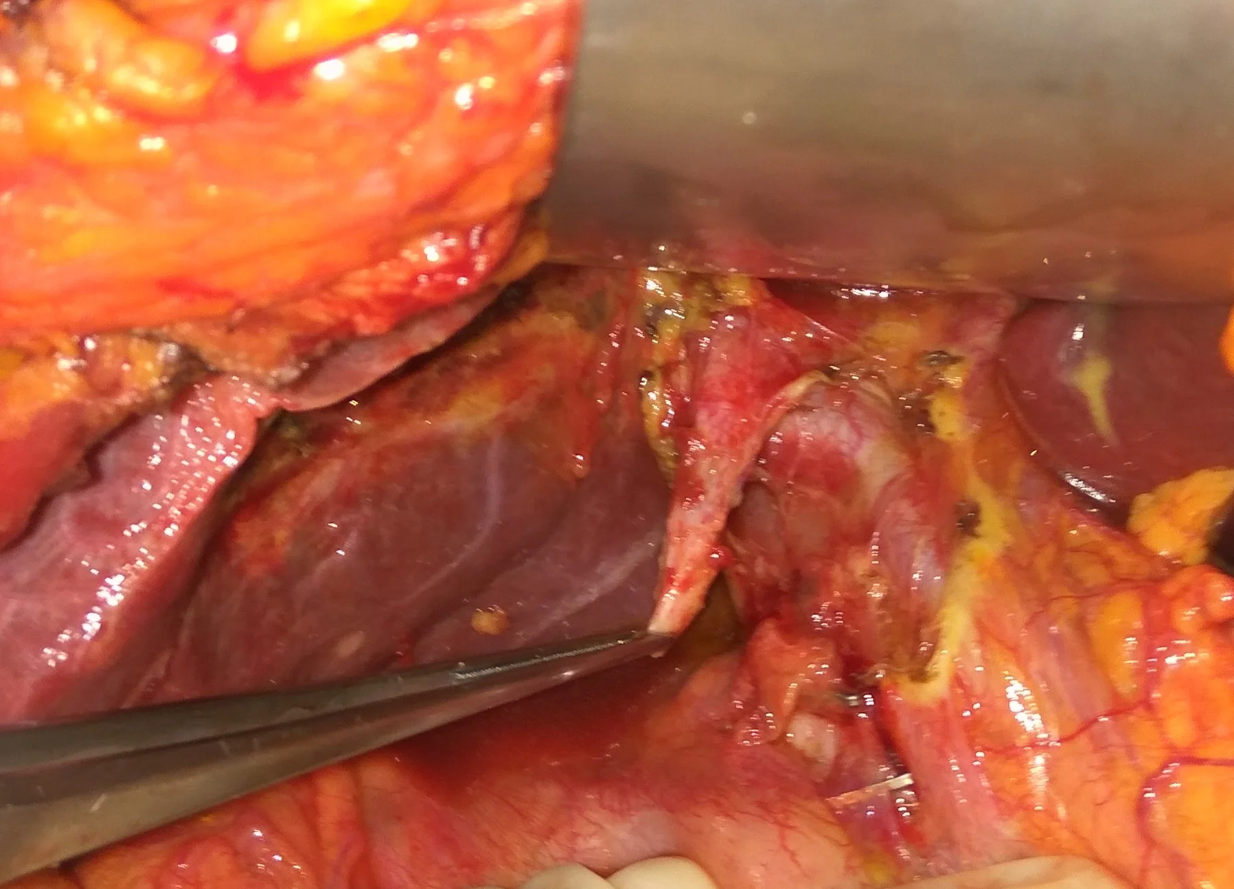 IATROGENIC TRANSECTION OF COMMON BILE DUCT