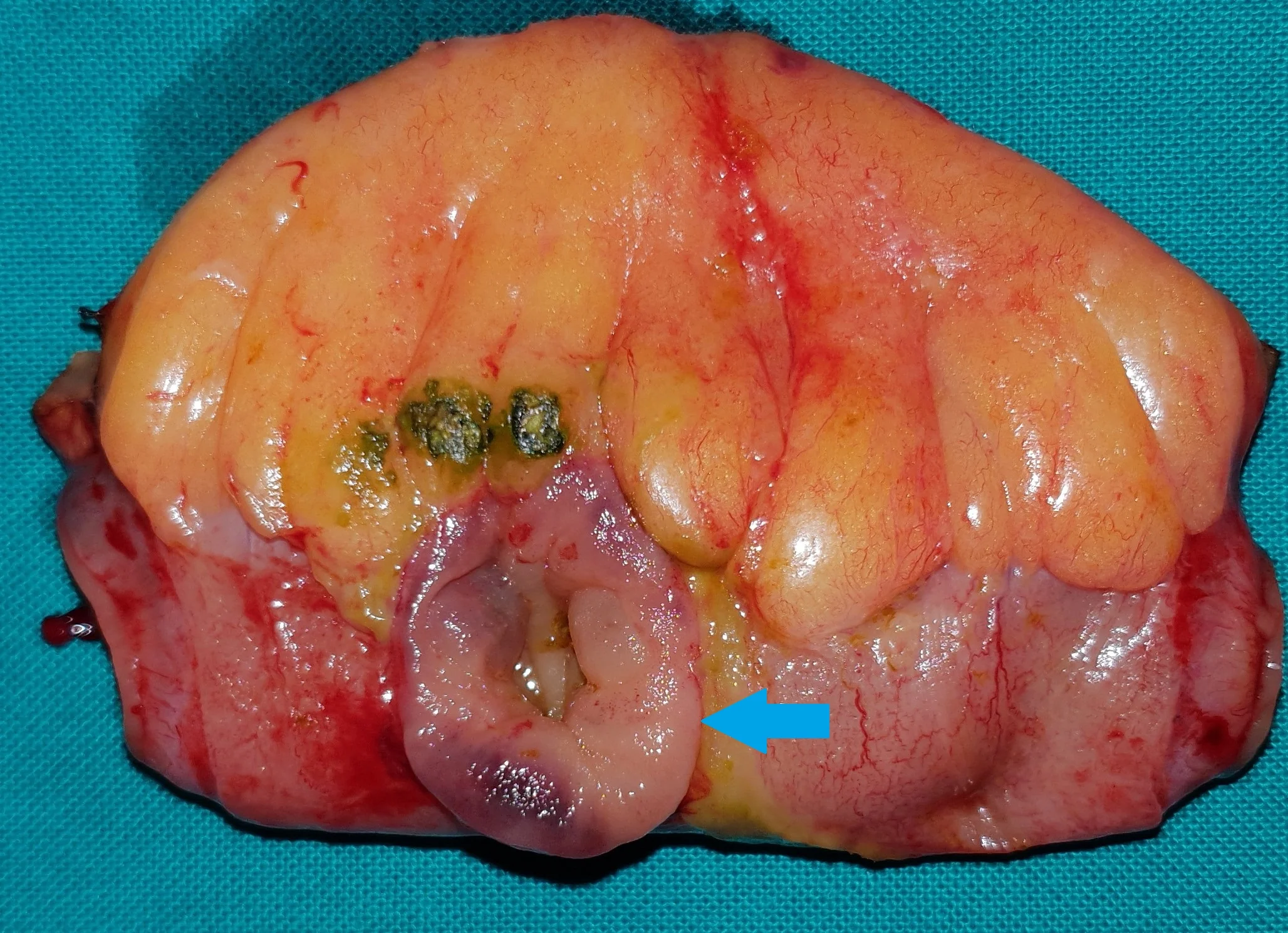 IATROGENIC SMALL BOWEL LACERATION