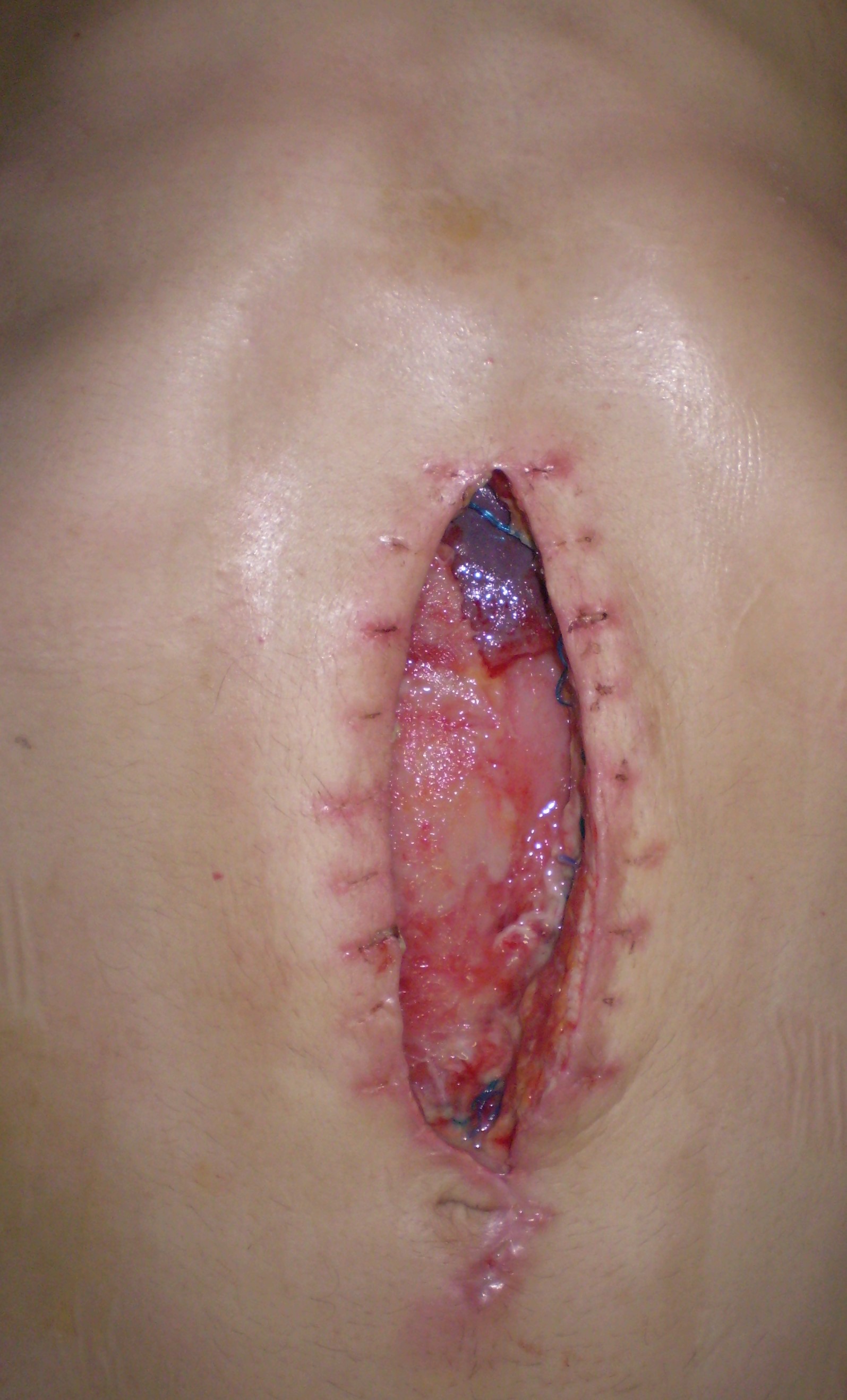SURGICAL WOUND DEHISCENCE