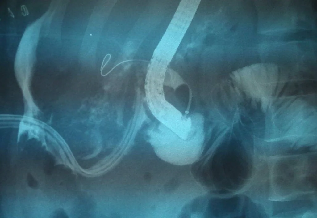 IATROGENIC BILIARY INJURY