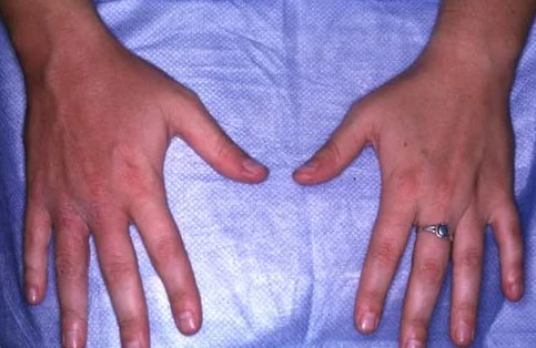 BEE STING