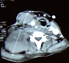 HUGE NECK HAEMATOMA
