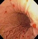 NASOGASTRIC SUCTION INJURY