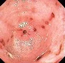 NASOGASTRIC SUCTION INJURY