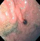 NASOGASTRIC SUCTION INJURY