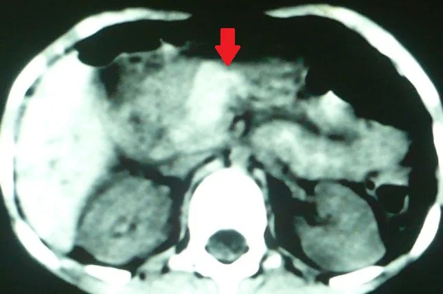 PANCREATIC CONTUSION 
