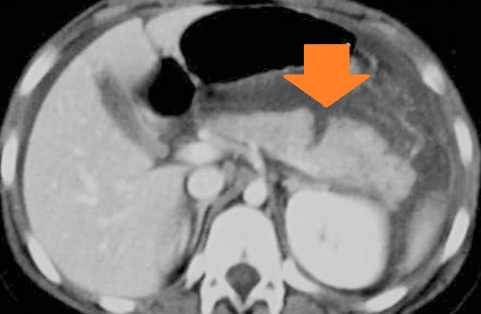 PANCREATIC LACERATION 