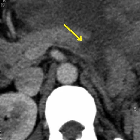 PANCREATIC TRAUMA