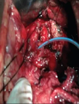 PANCREATIC TRAUMA 