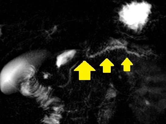 PANCREATIC TRAUMA