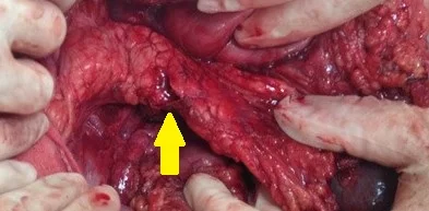 PANCREATIC TRAUMA 