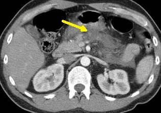 PANCREATIC TRAUMA 