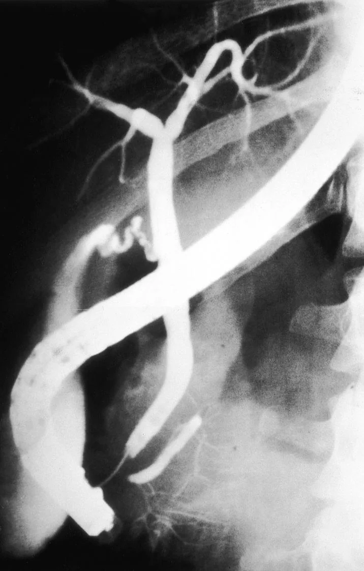 PANCREATIC TRAUMA 