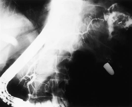 PANCREATIC TRAUMA 