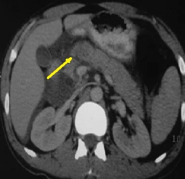 PANCREATIC TRAUMA