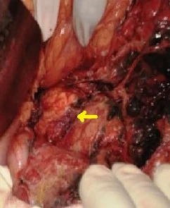 PANCREATIC TRAUMA 