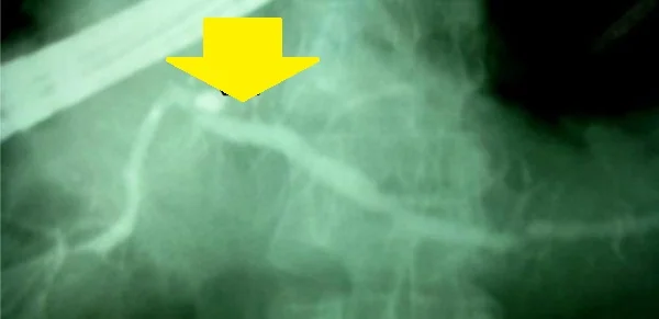 PANCREATICOGRAPHY - BULLET IN THE PANCREATIC DUCT