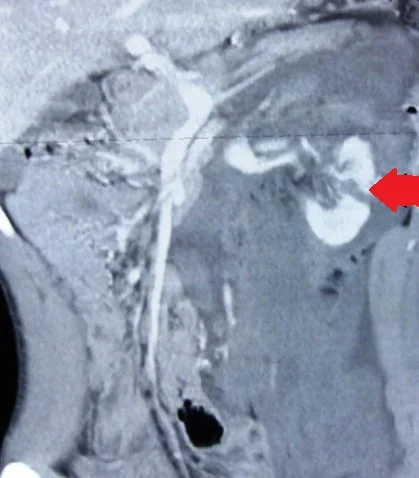 RENAL LACERATION