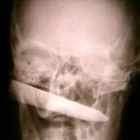 HEAD - KNIFE INJURY