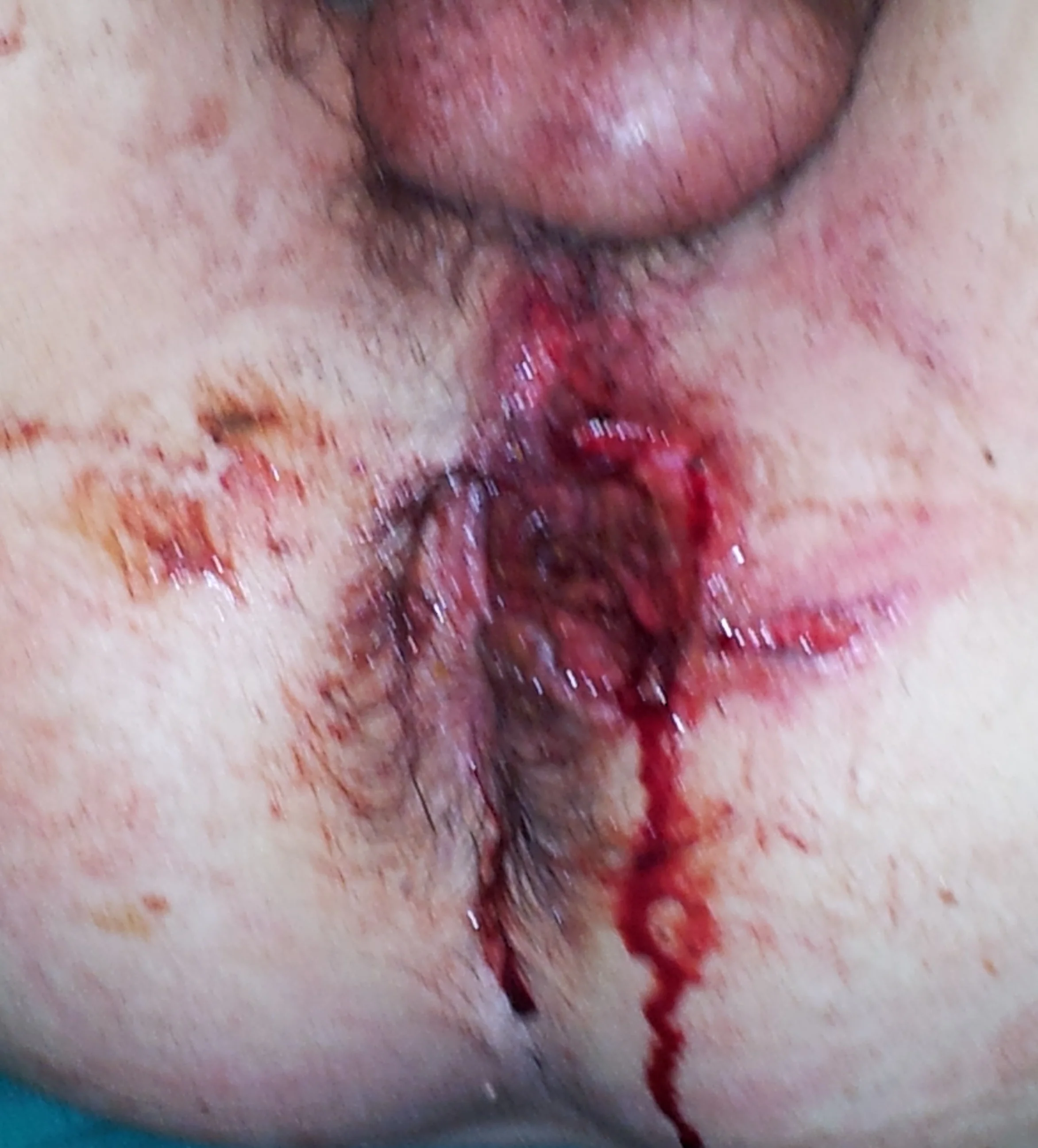 RECTAL LACERATION