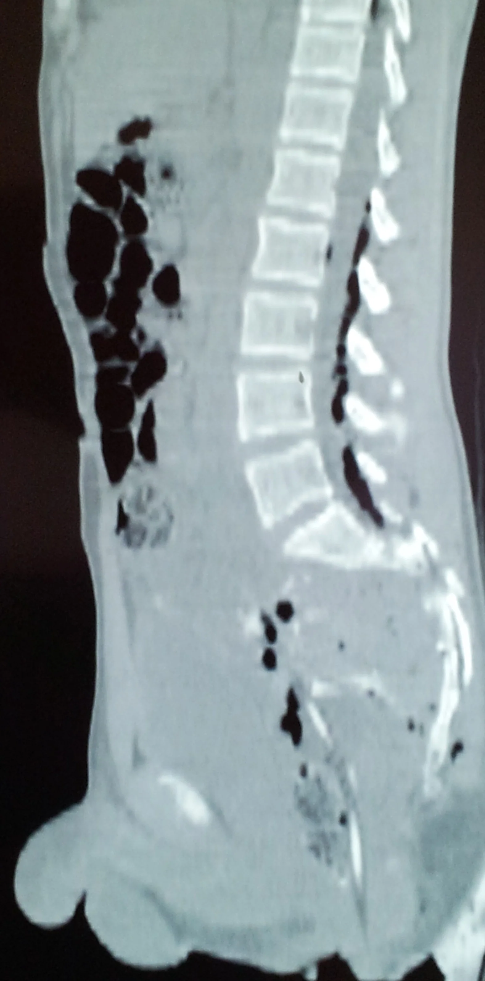 RECTAL LACERATION - PNEUMORACHIS