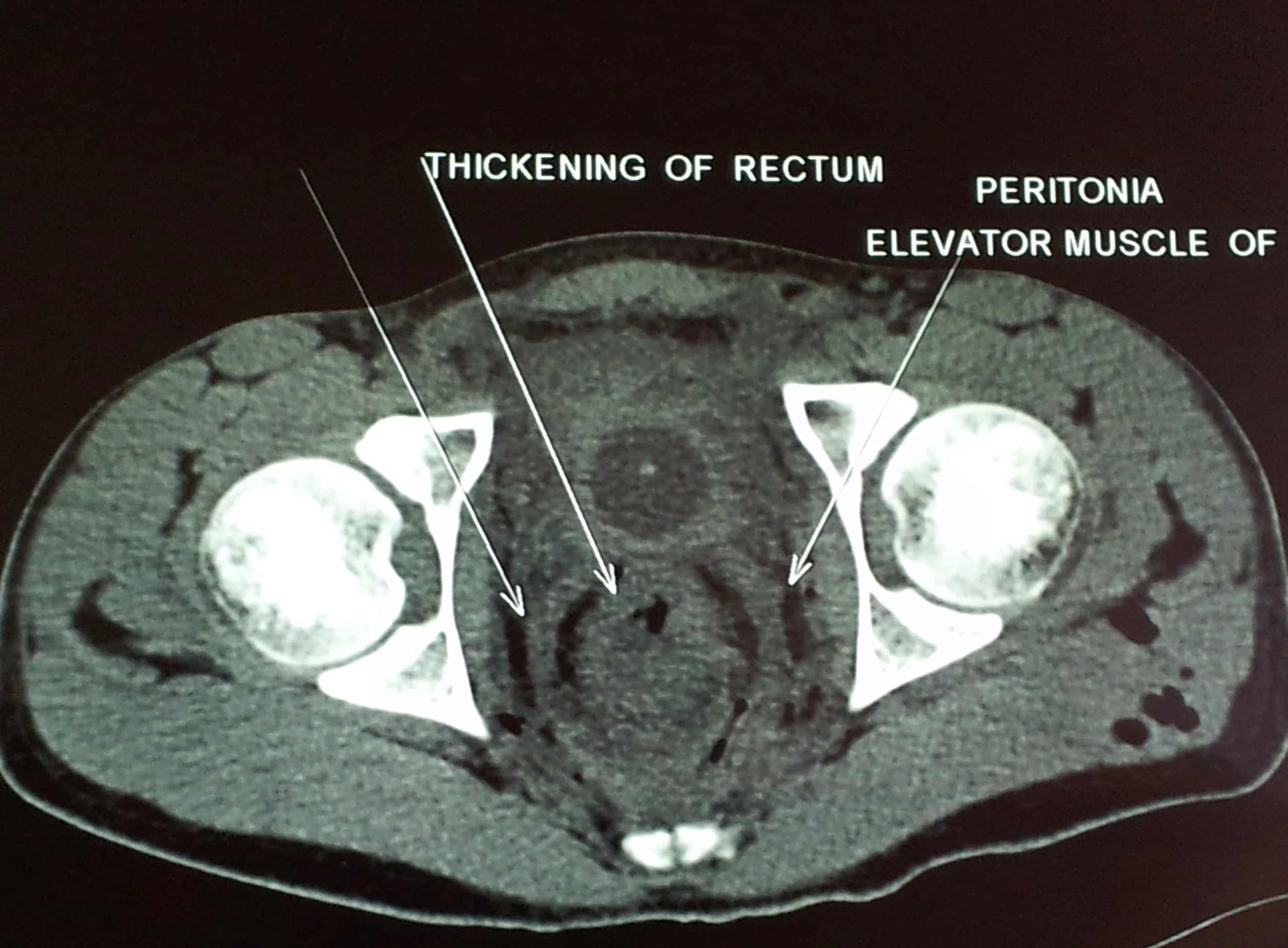 RECTAL ANATOMY