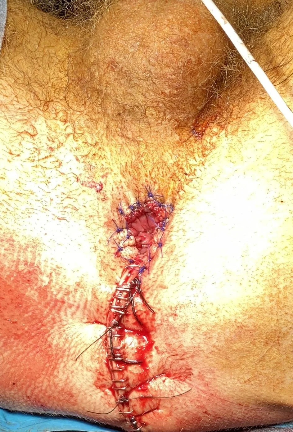 RECTAL LACERATION - REPAIR