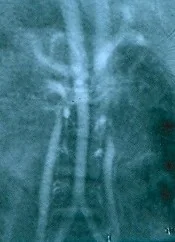 IVC THROMBOSIS