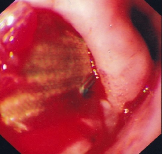 AORTO-ESOPHAGEAL FISTULA