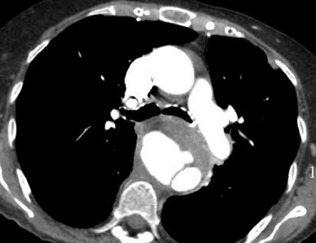 AORTO-ESOPHAGEAL FISTULA