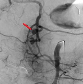 GASTRODUODENAL ARTERY PSEUDOANEURYSM