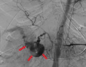 BLEEDING GASTRODUODENAL ARTERY 