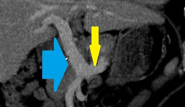 PORTAL VEIN ECTASIA