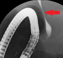 PORTAL VEIN ANEURYSM - COMMON BILE DUCT STENOSIS