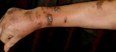VASCULITIS