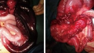 SUPERIOR MESENTERIC VEIN OCCLUSION