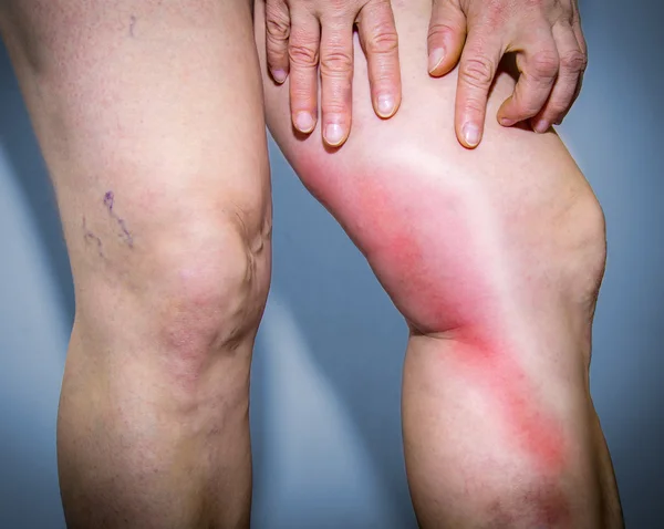 THROMBOPHLEBITIS