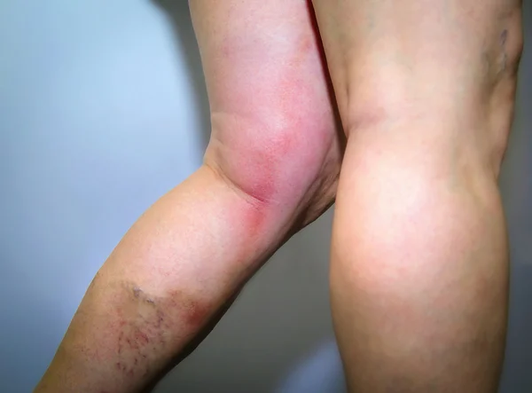 THROMBOPHLEBITIS