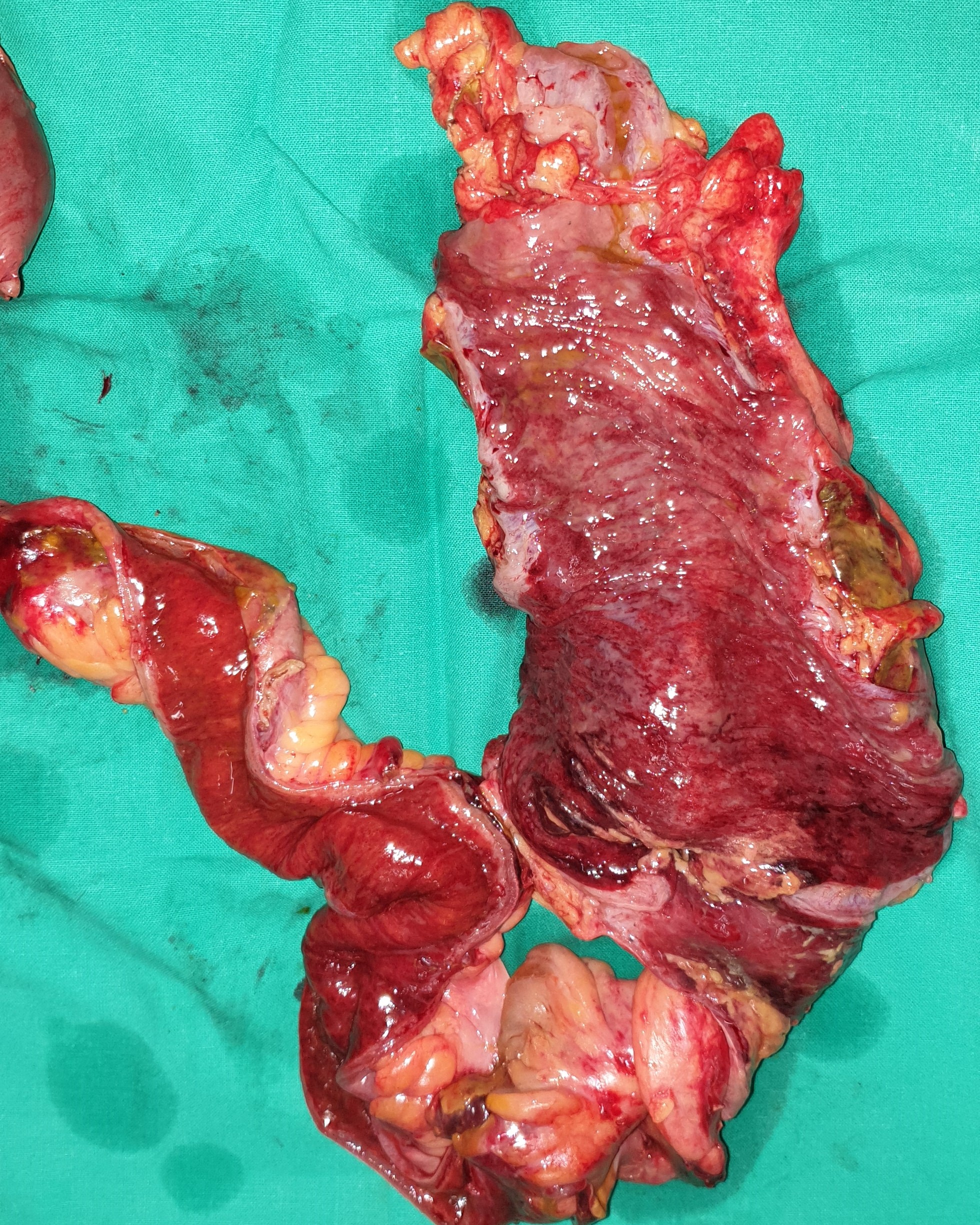 RUPTURED ABDOMINAL AORTIC ANEURYSM - SIGMOID ISCHAEMIA