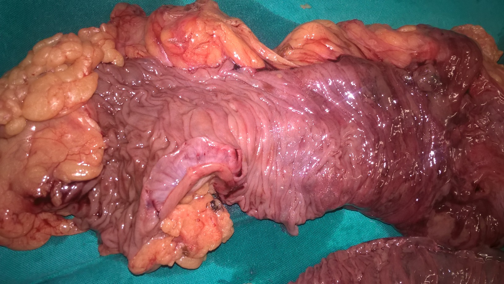 INTESTINAL ISCHAEMIA