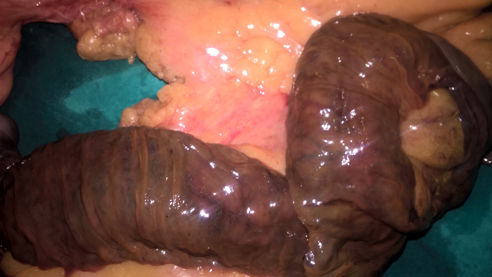INTESTINAL ISCHAEMIA