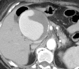 RUPTURE COMMON HEPATIC ARTERY PSEUDOANEURYSM